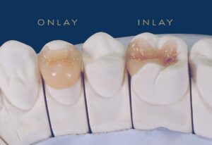 İnley ve Onley Diş Restorasyonları
