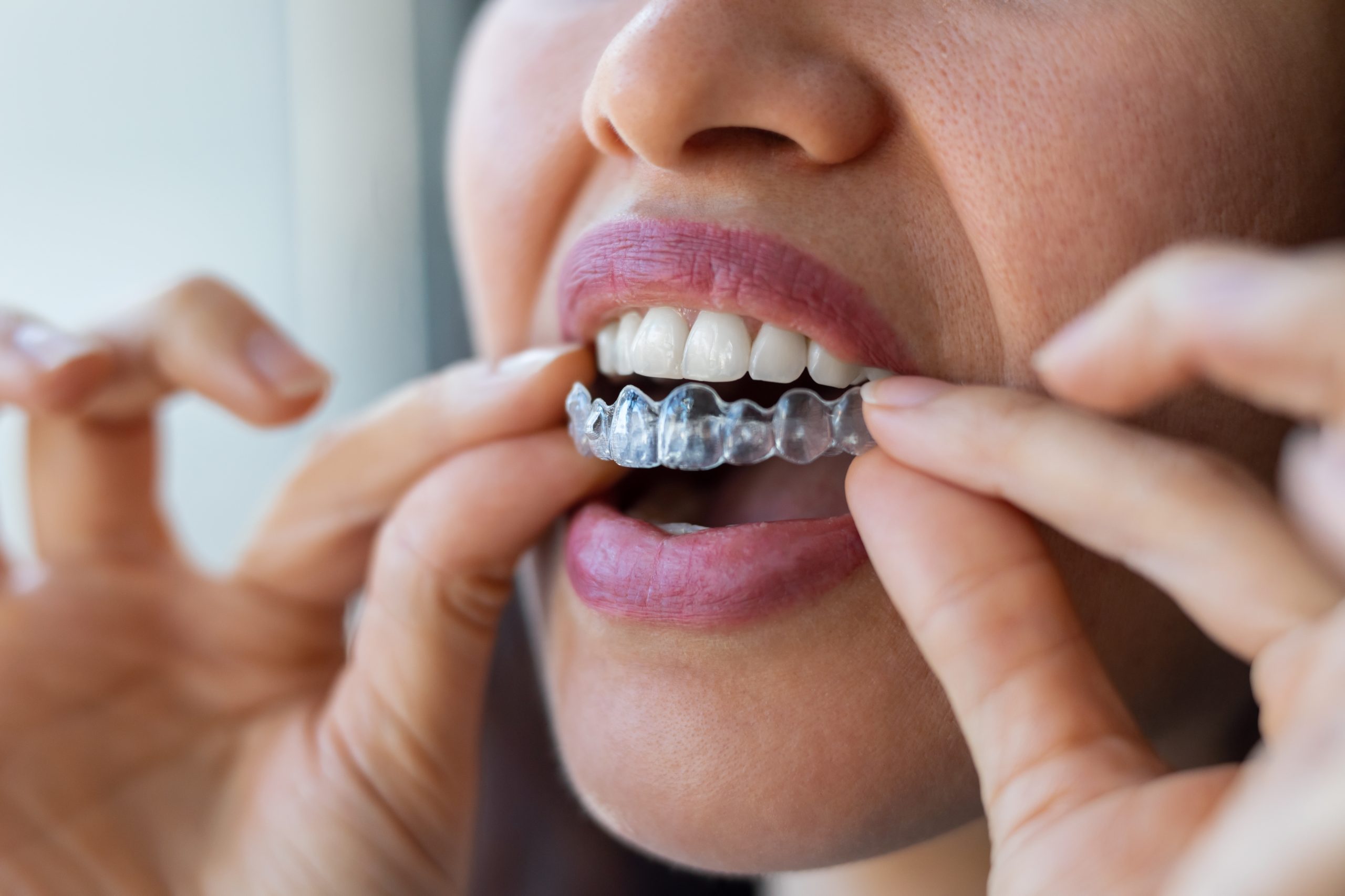 Şeffaf Plak Tedavisi (Invisalign)