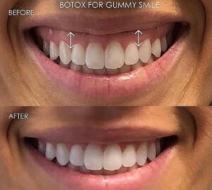 Gummy Smile (Diş Eti Gülüşü) 2026: Lazerle Kusursuz ve Estetik Gülüş Tasarımı Rehberi