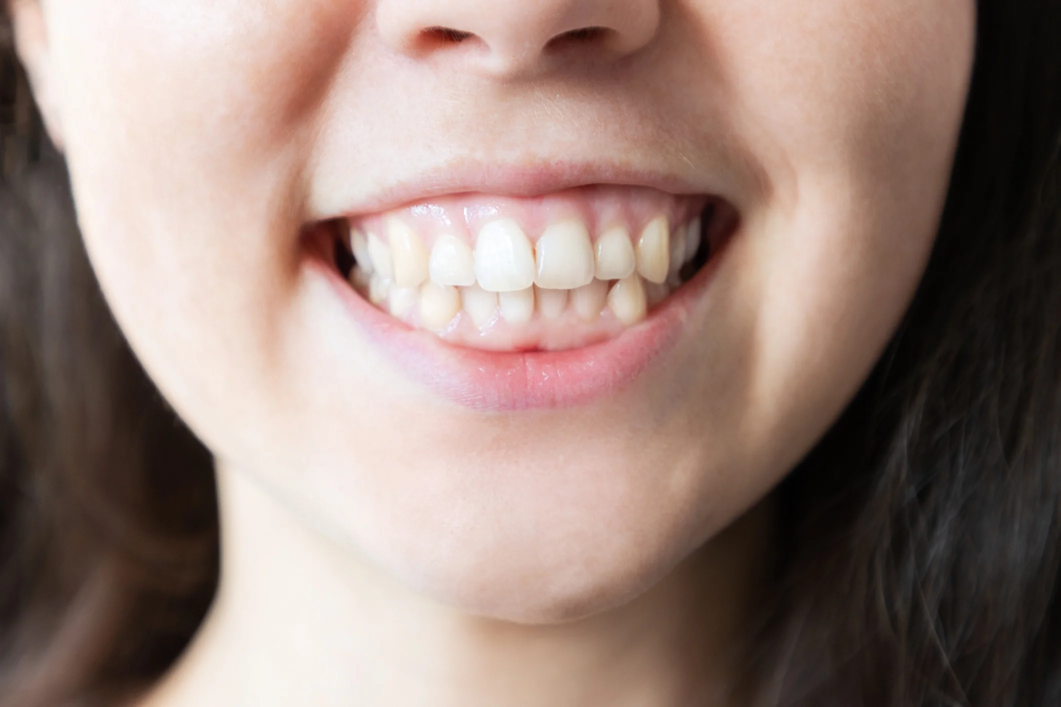 Gummy Smile (Diş Eti Gülüşü) 2026: Lazerle Kusursuz ve Estetik Gülüş Tasarımı Rehberi