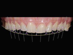 Digital Smile Design 2026: Kusursuz Bir Gülüş İçin Tedavi Öncesinde Sonuçları Görmek Mümkün mü?