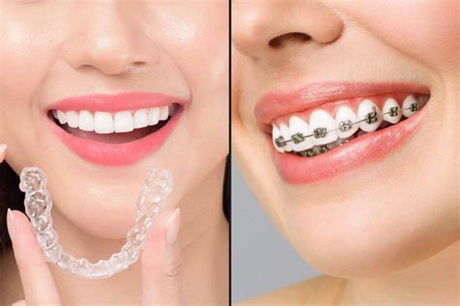 Şeffaf Plak (Invisalign) Tedavisi ile Diş Teli Kullanmadan Dişler Nasıl Düzelir? - Luna Dental Klinik 2026
