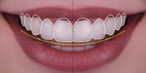 Gülüş Tasarımında 2026 Trendleri: Doğal ve Estetik Bir Gülüşe Nasıl Ulaşılır? - Luna Dental Klinik