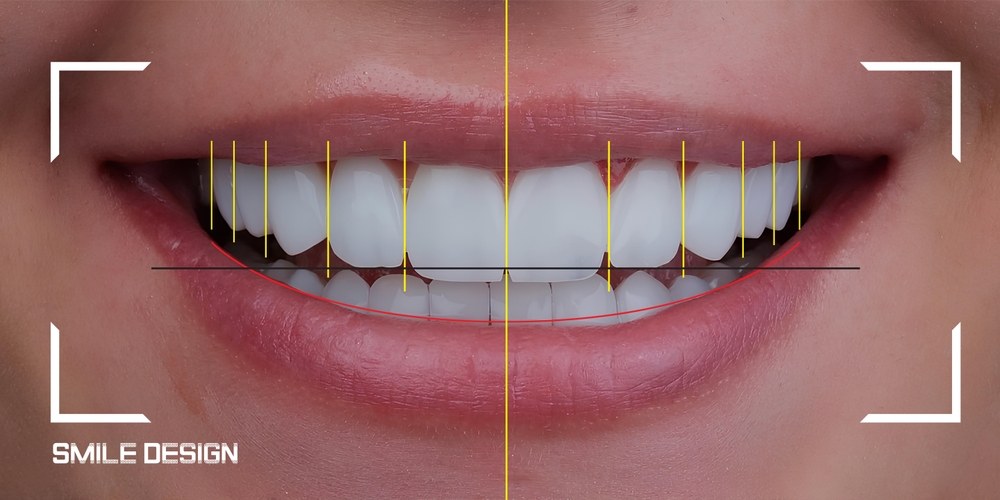 Gülüş Tasarımında 2026 Trendleri: Doğal ve Estetik Bir Gülüşe Nasıl Ulaşılır? - Luna Dental Klinik