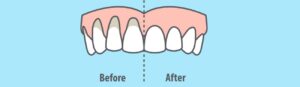 Diş Eti Çekilmesi Neden Olur? 2026 Yılının En Etkili Doğal Yöntemleri ve Luna Dental Klinik Tedavi Rehberi