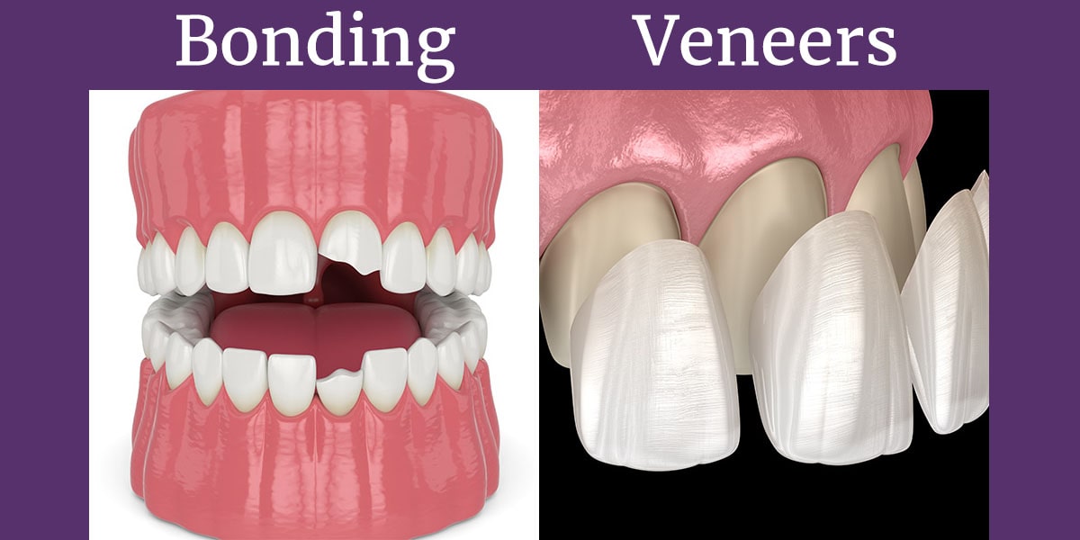 Bonding Uygulaması mı, Lamina Diş Kaplama mı? 2026'da Sizin İçin En İyisi Hangisi? - Luna Dental Klinik