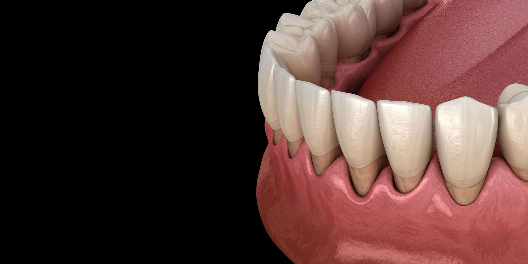 Diş Eti Çekilmesi Neden Olur? 2026 Yılının En Etkili Doğal Yöntemleri ve Luna Dental Klinik Tedavi Rehberi