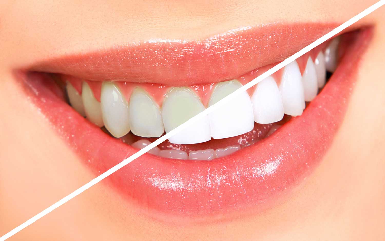 Diş Beyazlatma (Bleaching) Zararlı mı? Uzman Görüşü ve Güvenli Beyazlatma Yöntemleri - Luna Dental Klinik
