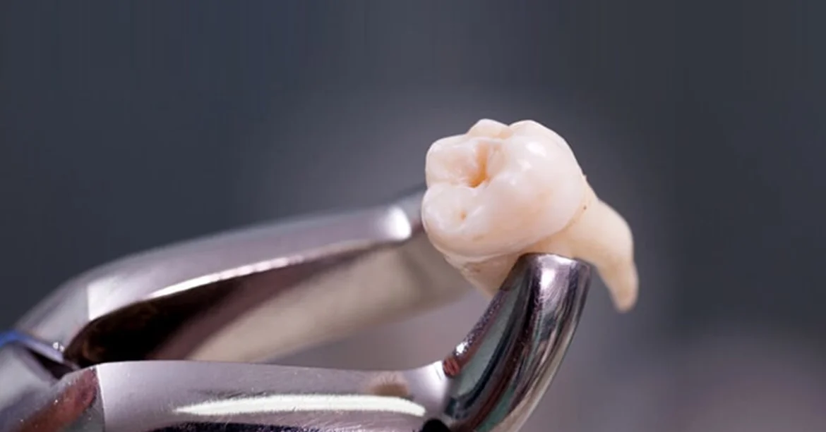 20 Yaş Dişi Çekimi Sonrası İyileşme Süreci İçin En Etkili Rehber - Luna Dental Klinik