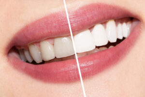 Diş Beyazlatma (Bleaching) Zararlı mı? Uzman Görüşü ve Güvenli Beyazlatma Yöntemleri - Luna Dental Klinik