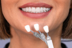 Porselen Lamina ile Hollywood Smile İşlem Süreci ve Kalıcılık Süresi 2026 – Luna Dental Klinik
