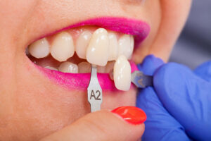 Porselen Lamine (Yaprak Diş) Kimlere Yapılır? Aşamaları ve Ömrü | Luna Dental Klinik Ankara